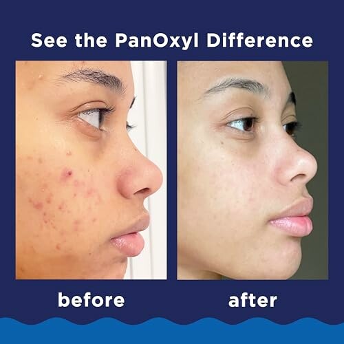 Before and after comparison of skin treatment using PanOxyl.